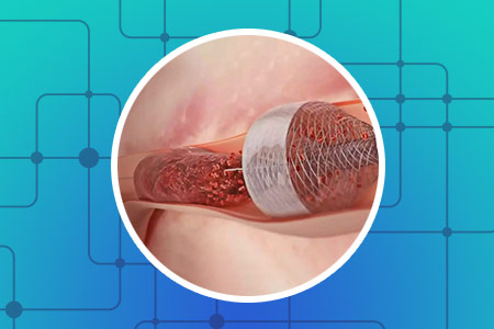 Tromb�lise Mec�nica (AVC Isqu�mico)