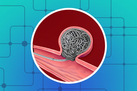 Emboliza��o (Aneurismas Intracranianos)