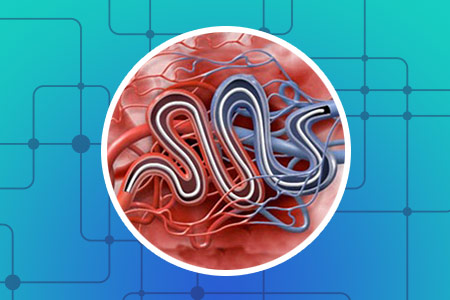 Emboliza��o (Malforma��es Vasculares Cerebrais)