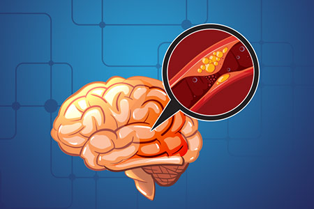 Acidente Vascular Cerebral (AVC)