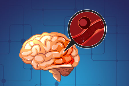 Aneurismas Intracranianos