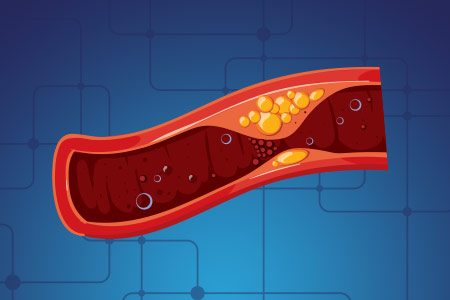 Aterosclerose e Estenose da Art�ria Car�tida