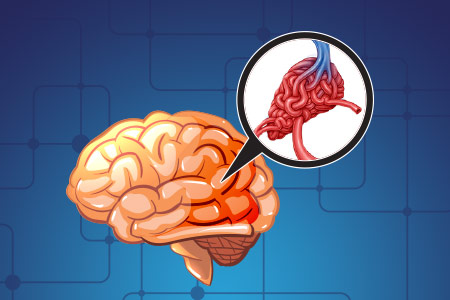Malforma��es Vasculares Cerebrais